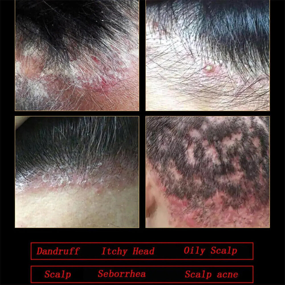 Natural Scalp & Hair Follicle Shampoo for Dandruff Itching Oil Control 200ml