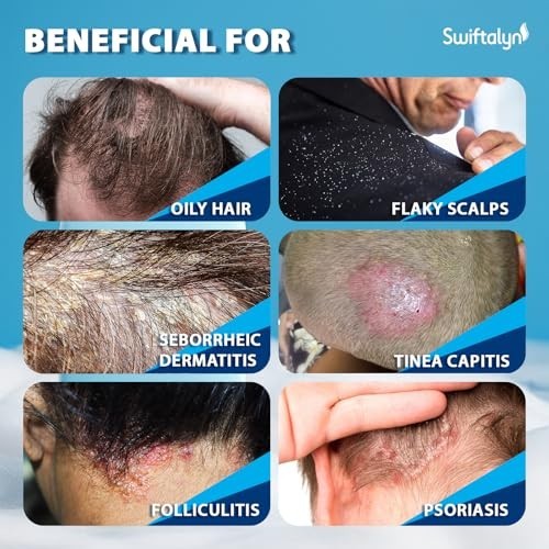 Antifungal Shampoo for Scalp Care Dandruff Seborrheic Dermatitis Relief