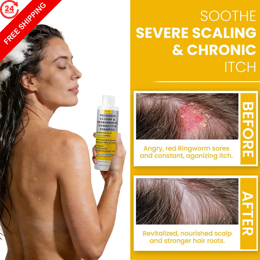 Salicylic Acid Psoriasis Shampoo - 6.76 Fl Oz, Scalp Relief & Moisturizing