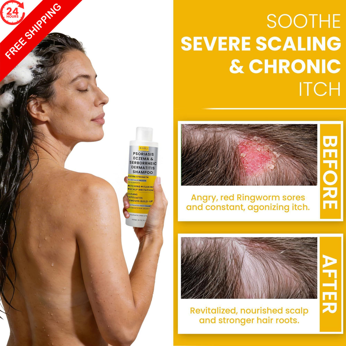 Salicylic Acid Psoriasis Shampoo - 6.76 Fl Oz, Scalp Relief & Moisturizing