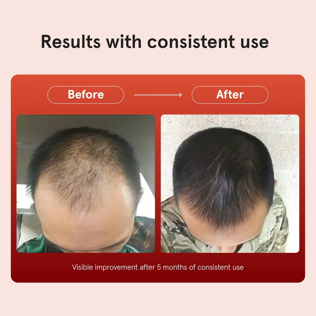 Men's Minoxidil 5% Hair Regrowth Solution - 3 Bottles, 2 fl oz Each