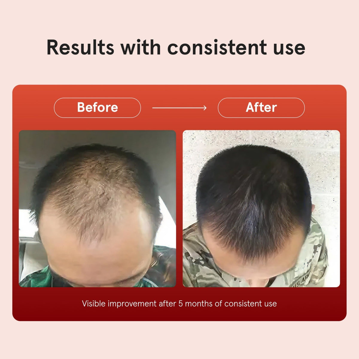 Men's Minoxidil 5% Hair Regrowth Solution - 3 Bottles, 2 fl oz Each