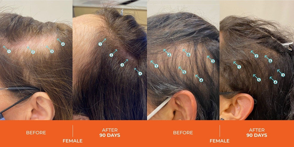 Revita Hair Stimulating Shampoo for Hair Loss & Thinning - 31.3 oz