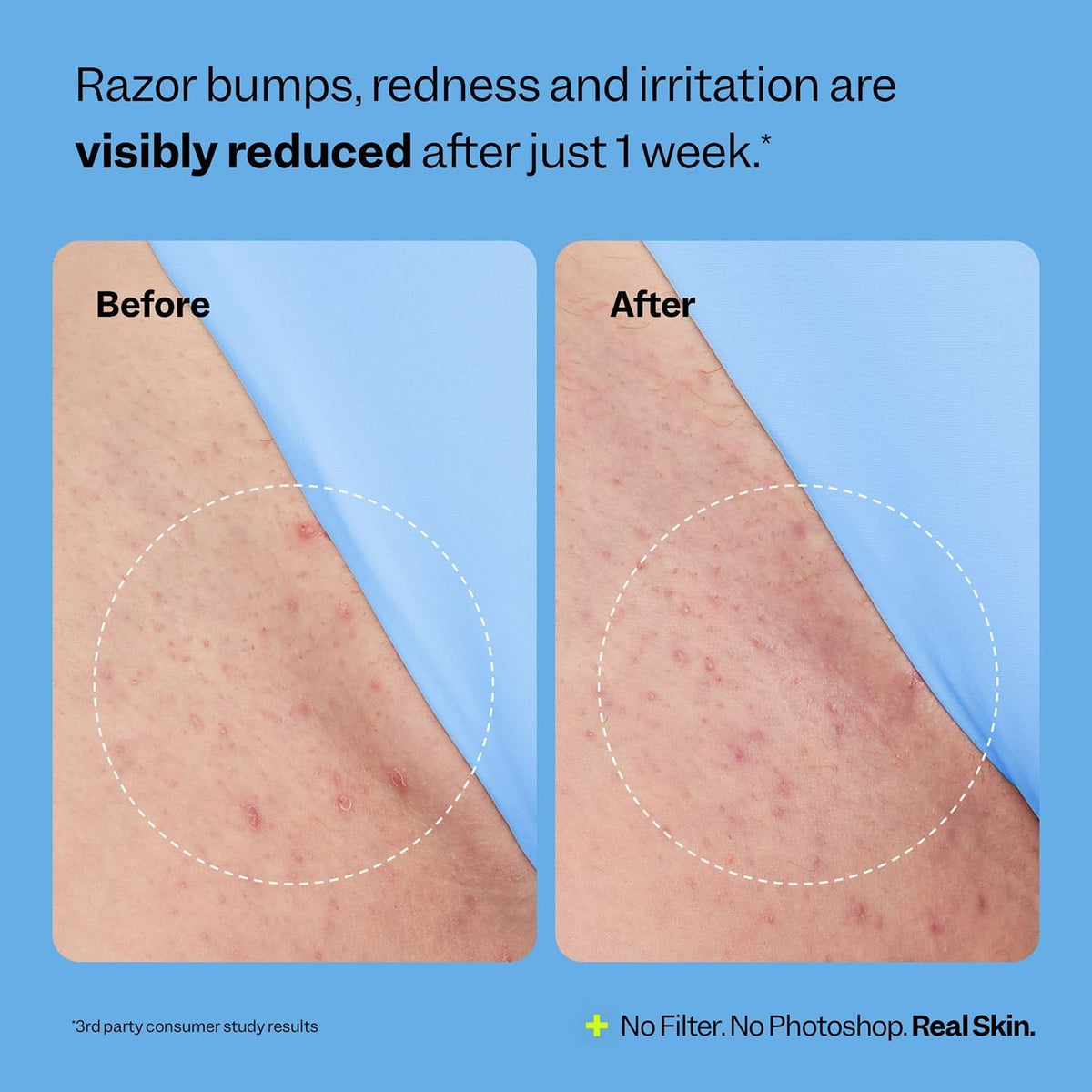 Ingrown Hair Treatment Roller - Smoothing Solution for Razor Bumps & Dark Spots 1.69 oz