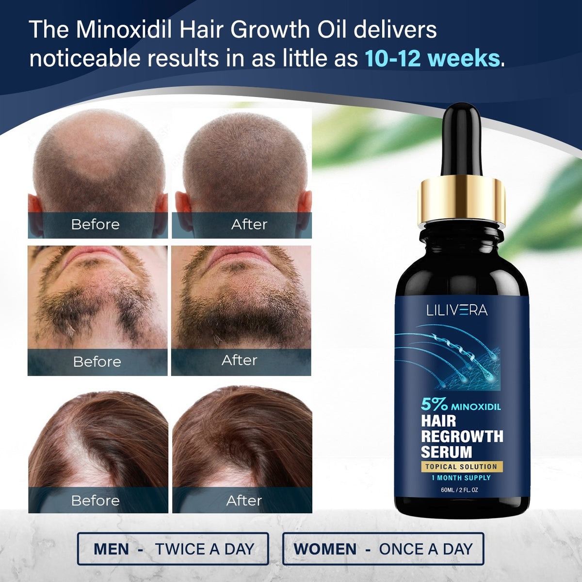 Minoxidil Hair Growth Kit with Derma Roller & Biotin for Men & Women