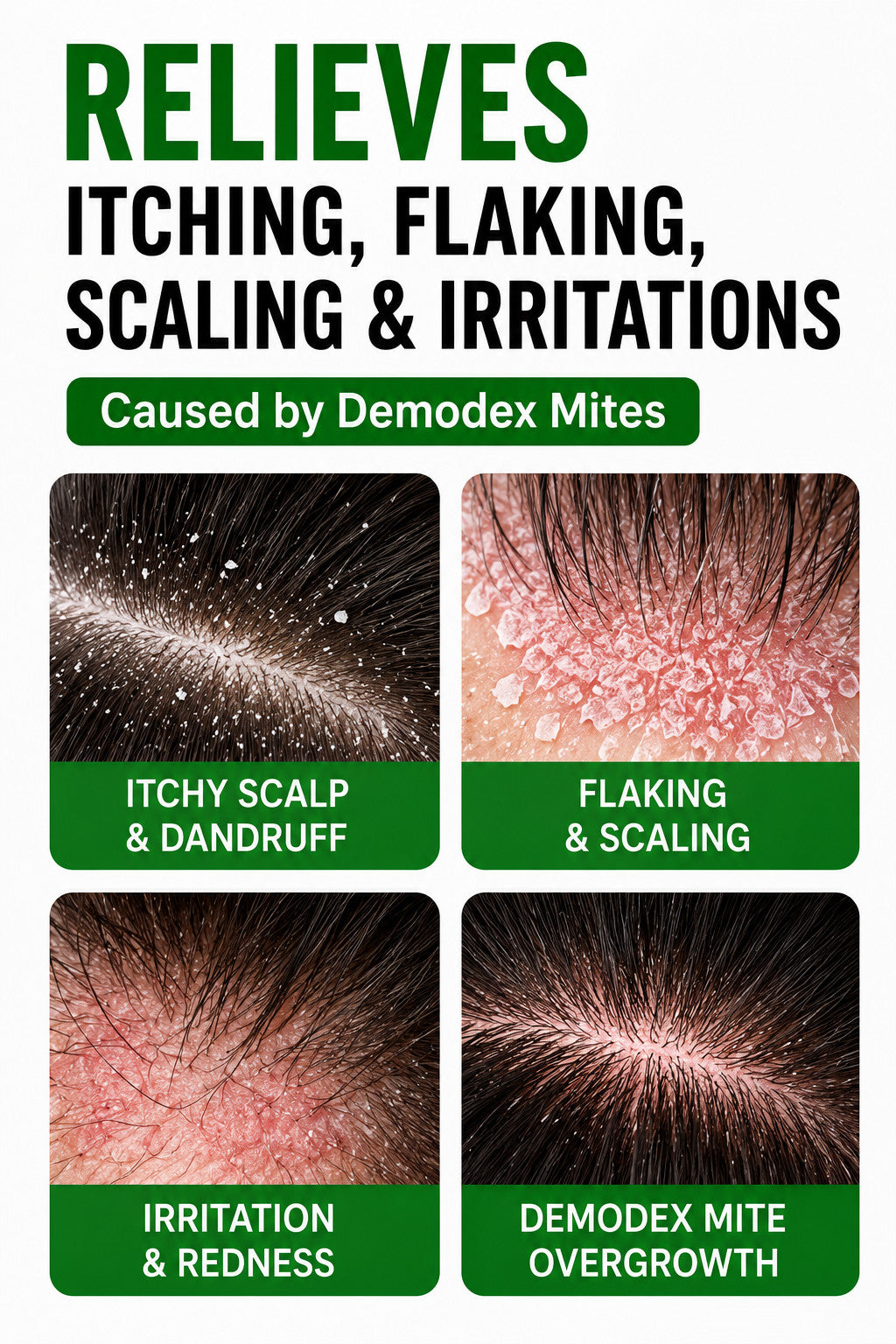 Demodex Hair & Scalp Treatment Mask - Extra Strength 6 oz for Dandruff & Hair Loss
