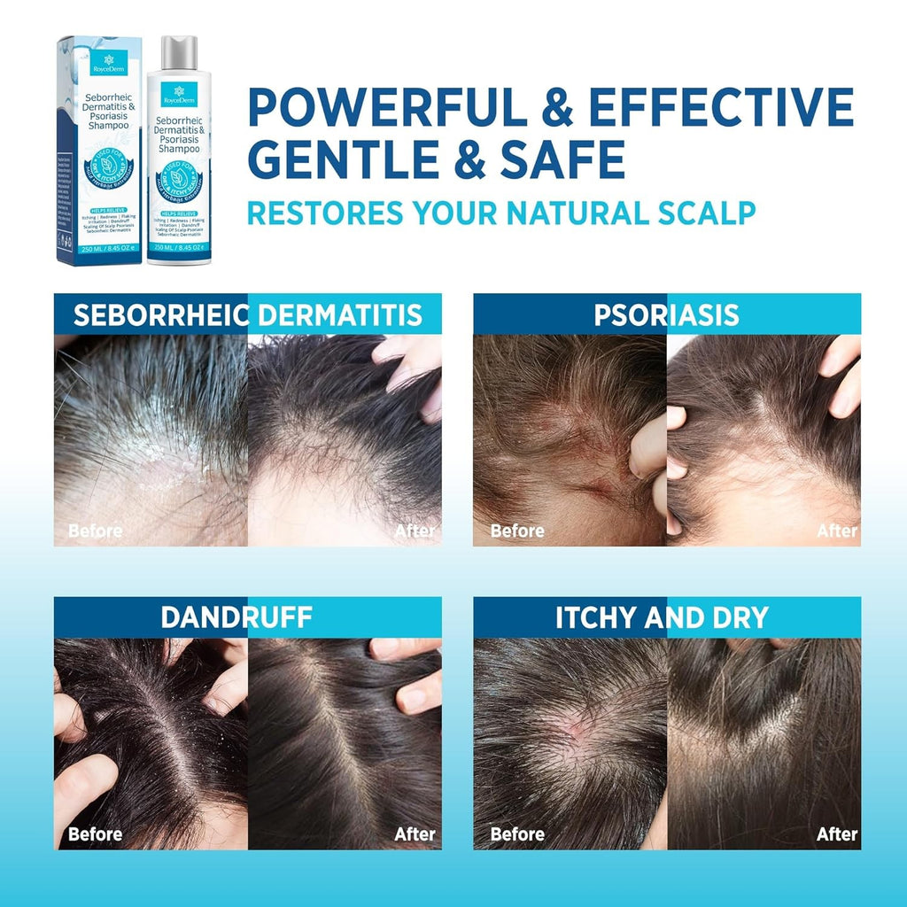 Seborrheic Dermatitis & Psoriasis Scalp Shampoo and Conditioner Set - Herbal Relief