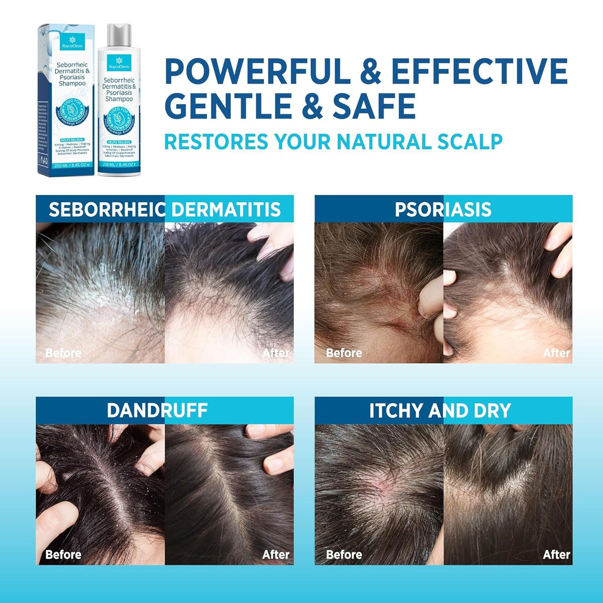 Seborrheic Dermatitis & Psoriasis Scalp Shampoo and Conditioner Set - Herbal Relief