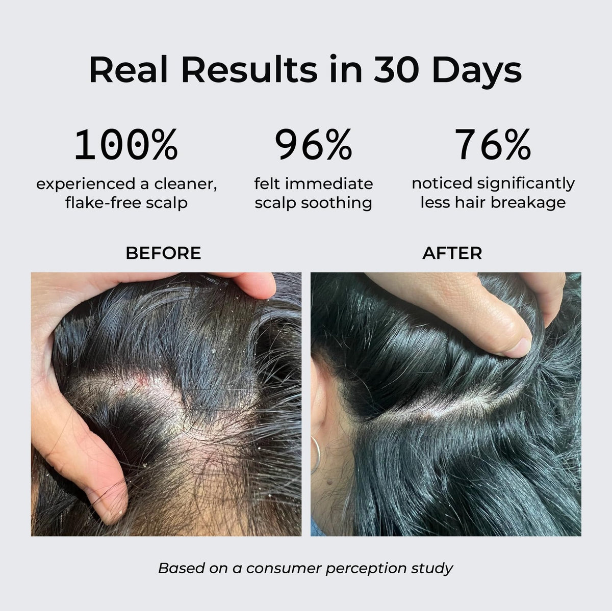 Anti Dandruff Shampoo with Natural Herbs & Nano Silver - 6.66 Fl Oz