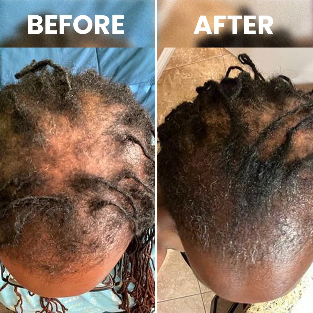Hair Growth Serum with Peppermint Nettle Rosemary Oil - 2 Pack