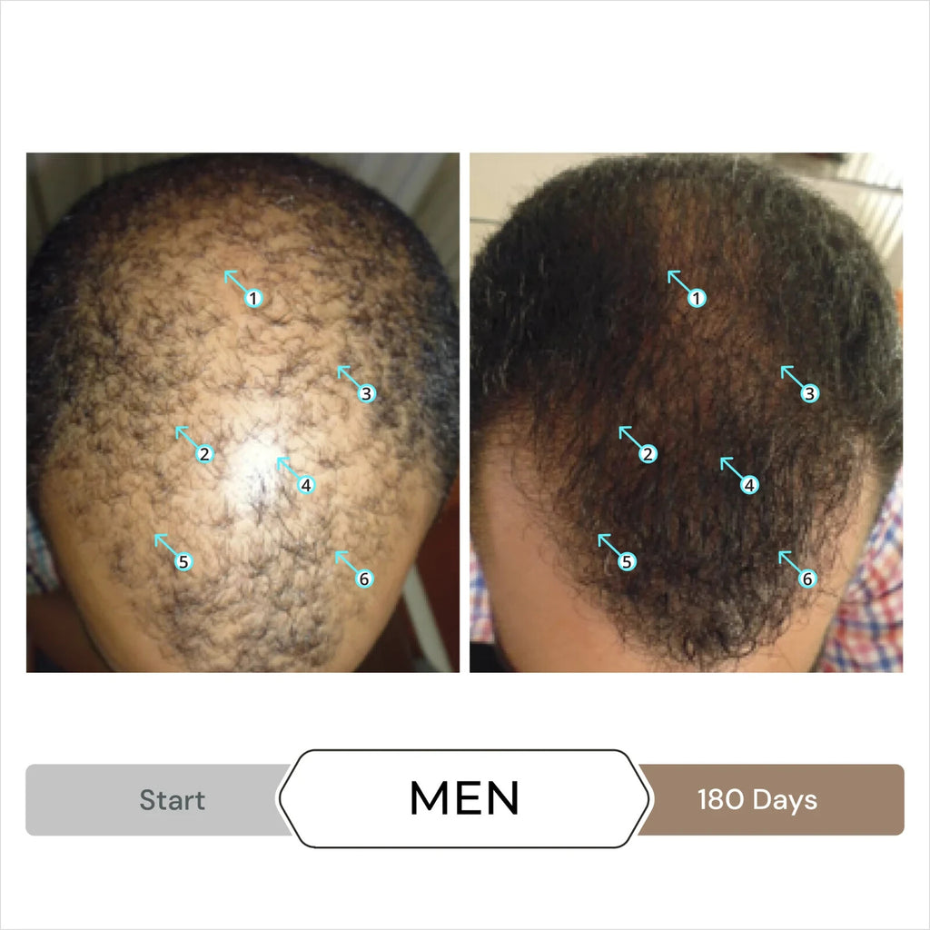 Hair Serum with Nanoxidil 5% for Hair Density & Thickness - 3 Month Supply