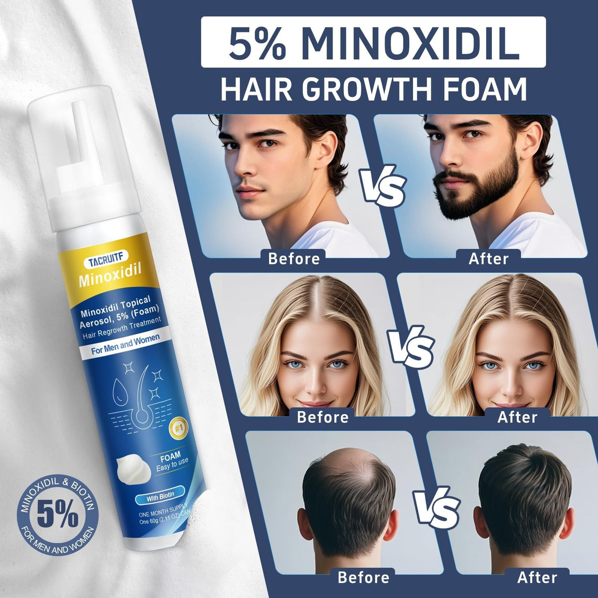 Hair Growth Foam with Minoxidil & Biotin for Thicker Hair & Beard - 5%