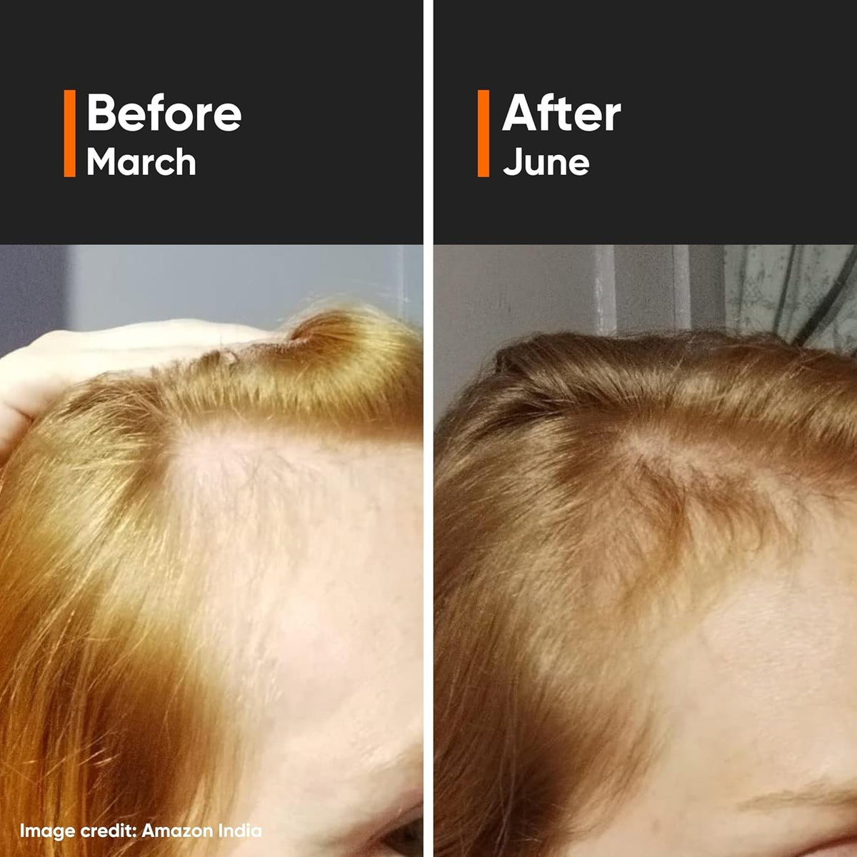 Hair Density Serum 18% with Procapil & Redensyl for Hair Fall Control - 30ml