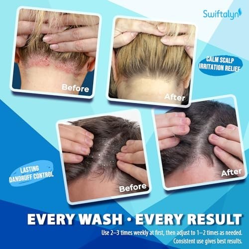 Antifungal Shampoo for Scalp Care Dandruff Seborrheic Dermatitis Relief
