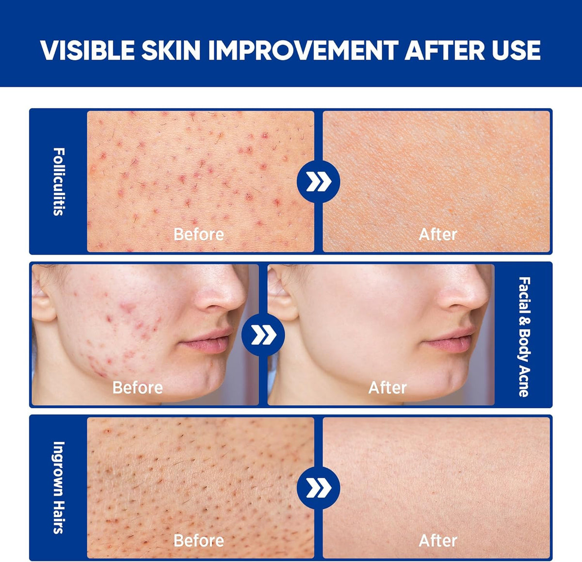 Folliculitis & Acne Treatment Cream with Salicylic Acid and Herbal Extracts for Scalp, Face, Body