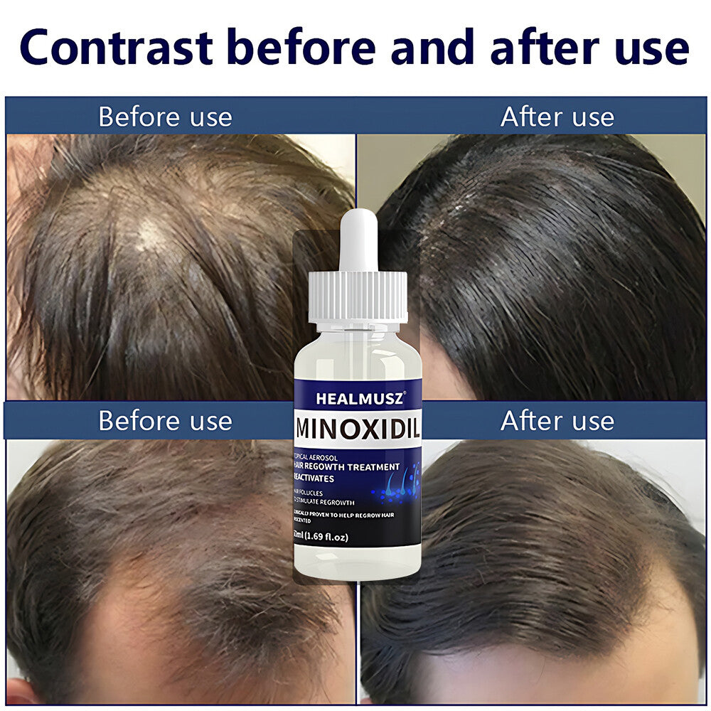 Men's Hair Regrowth Treatment with Minoxidil 5% - 4 Pack, 4 Month Supply