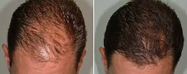 Hair Loss Regrowth Shampoo & Conditioner Set with 16 Natural Oils for Men Women