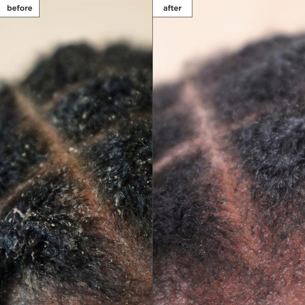 Scalp Treatment Serum with Charcoal and Tea Tree for Hair Care - Leave-In