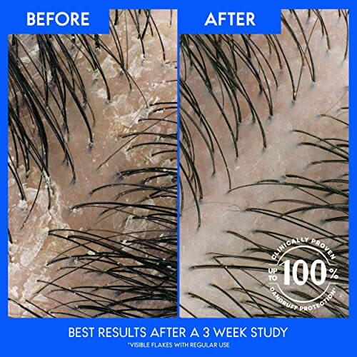 Anti-Dandruff Shampoo 32 Oz Pack of 2 for Flake-Free Scalp & Hair