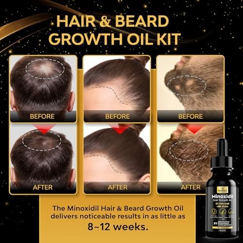 Minoxidil Beard & Hair Growth Kit 5% for Men & Women - Thickening Treatment