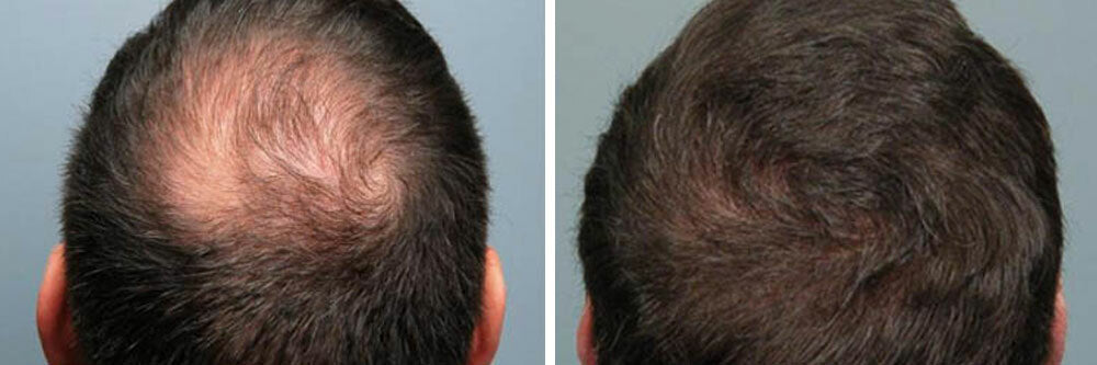Hair Loss Treatment Kit for Men & Women | Organic DHT Blocker & Regrowth Support