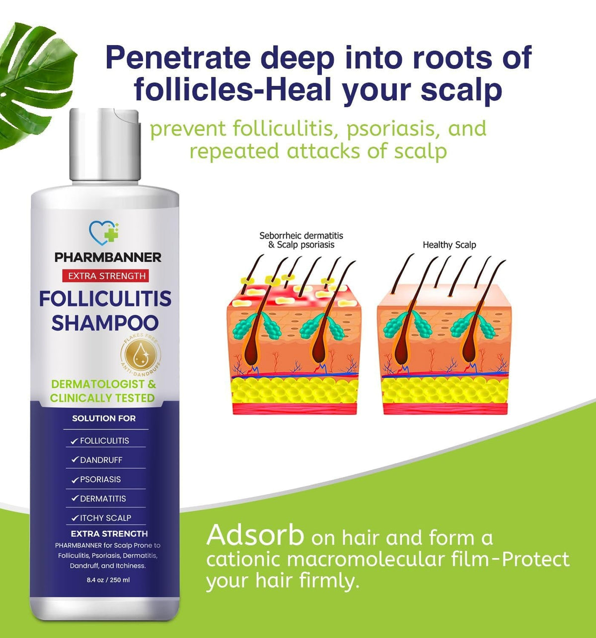 Anti-Fungal Shampoo for Folliculitis & Psoriasis - Soothes Dry Scalp Relief