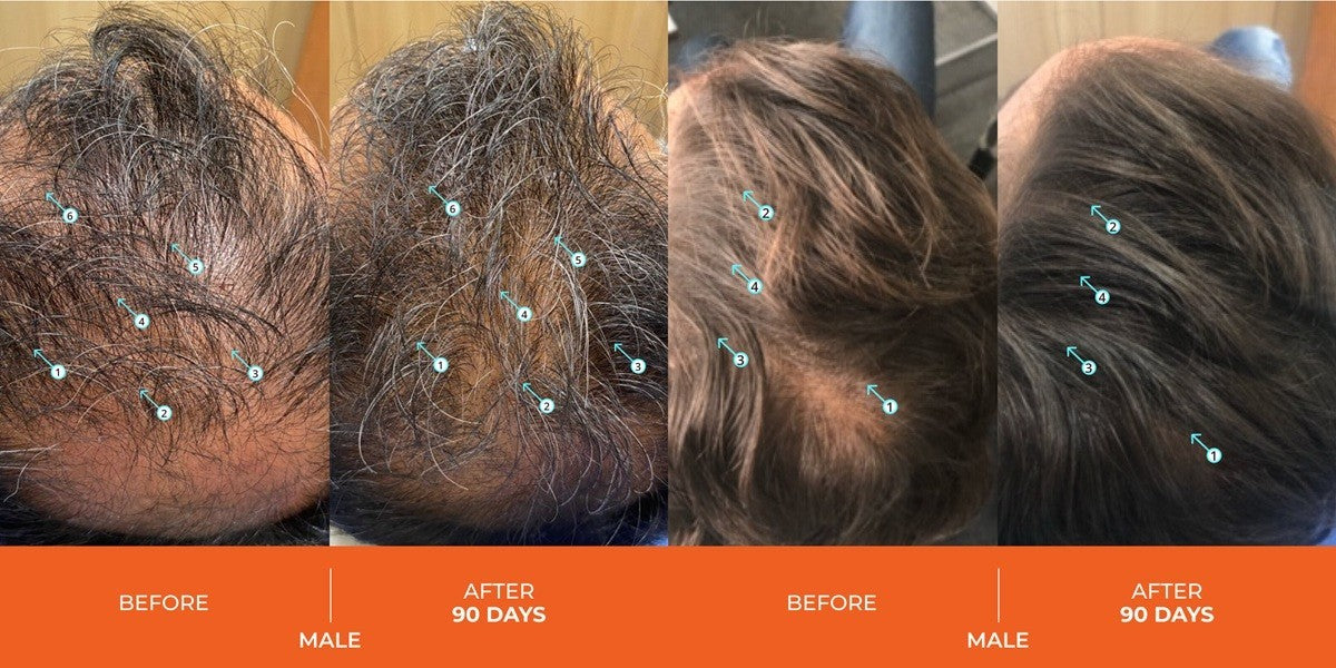 Revita Hair Stimulating Shampoo for Hair Loss & Thinning - 31.3 oz