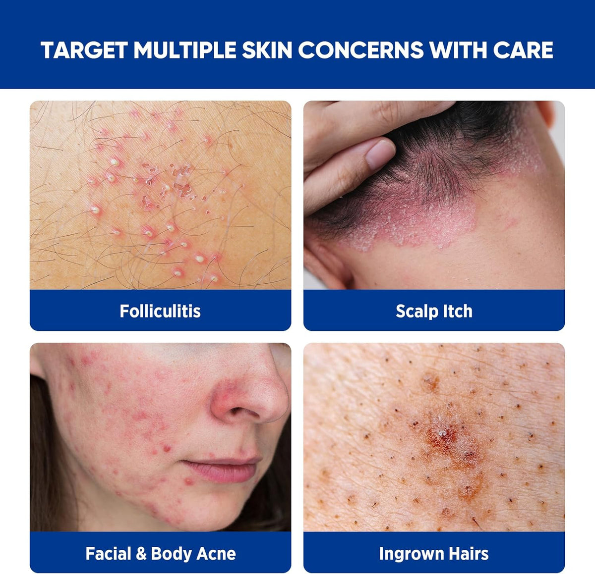 Folliculitis & Acne Treatment Cream with Salicylic Acid and Herbal Extracts for Scalp, Face, Body