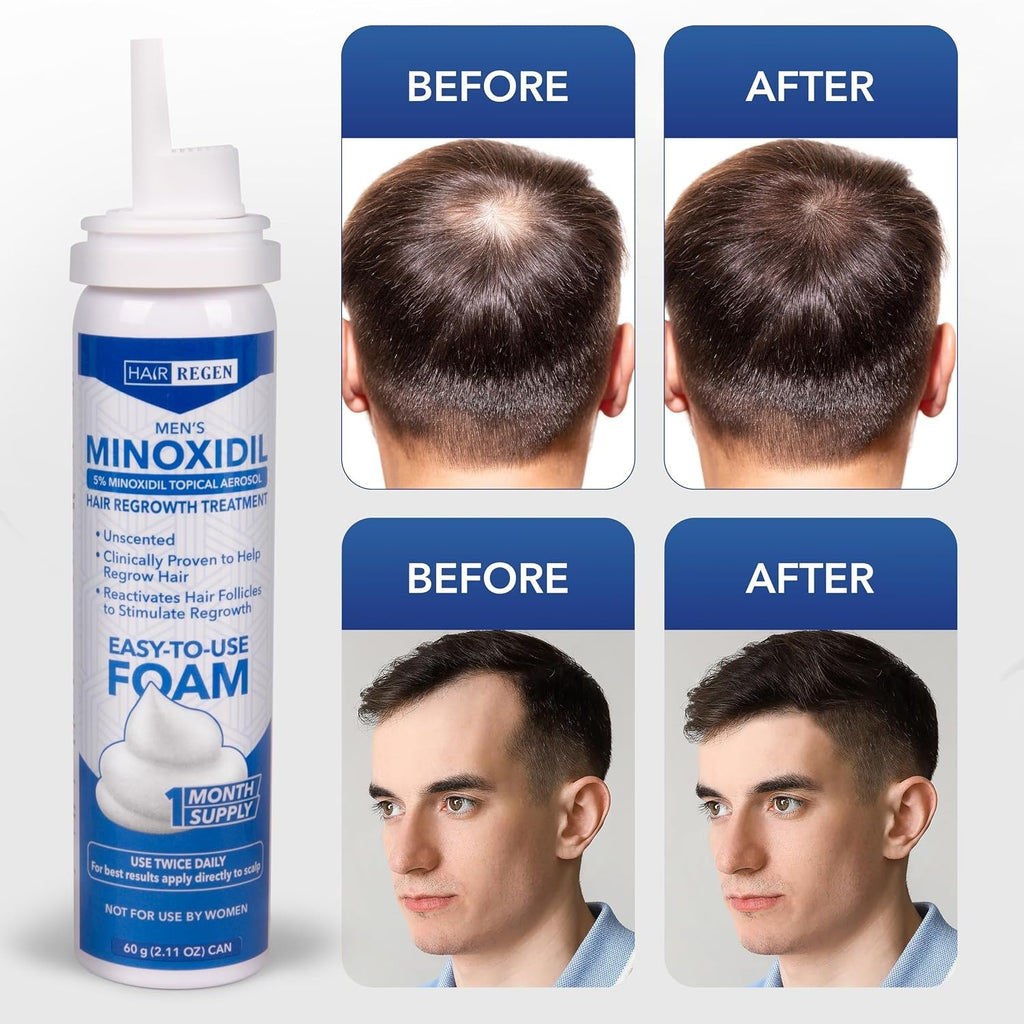 Men's 5% Minoxidil Foam Hair Regrowth Treatment for Thinning Hair