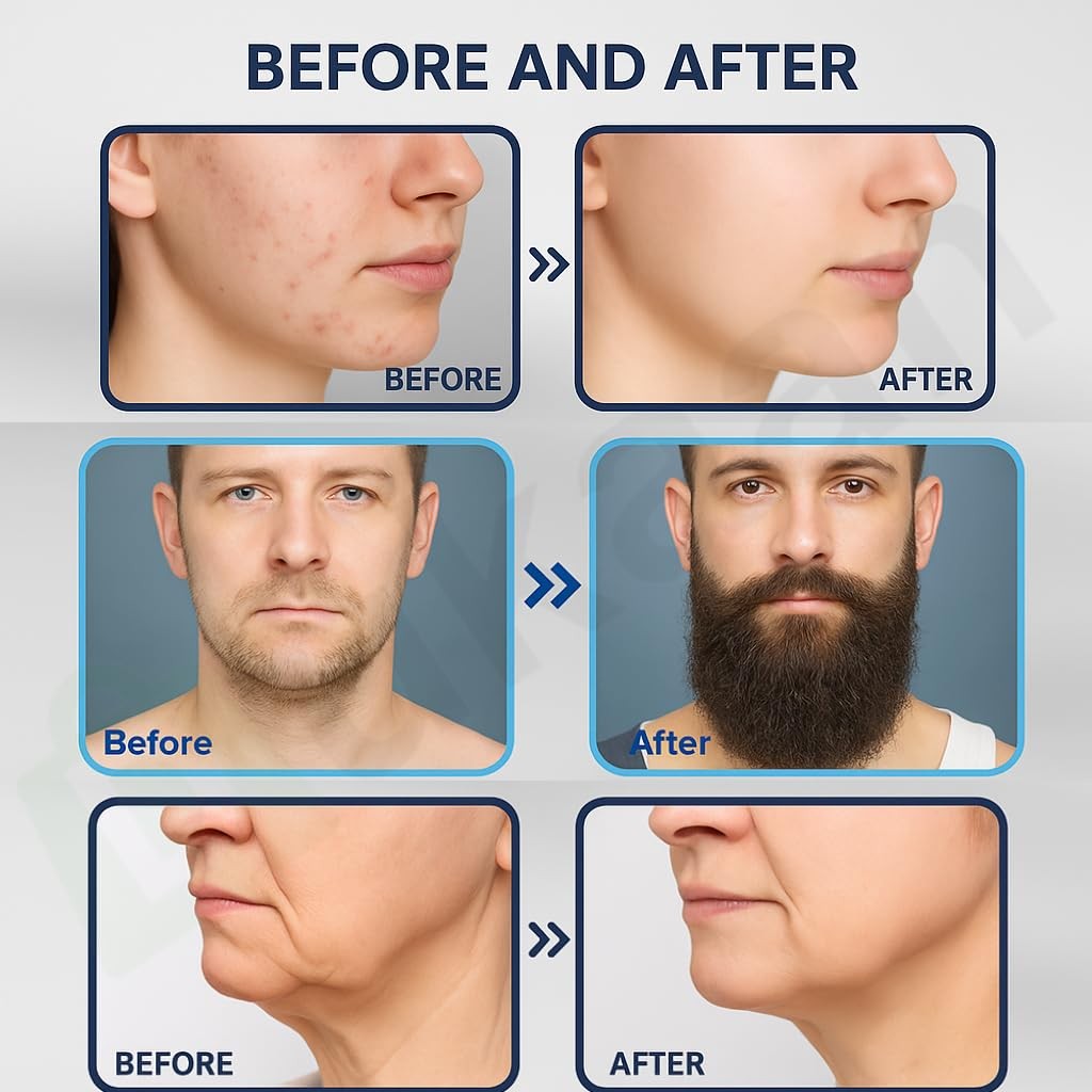 Microneedling Derma Stamp Kit for Hair & Beard Growth - Titanium 0-3mm